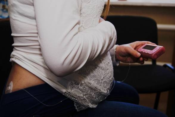 Планирование беременности для женщин с СД. Рекомендации эндокринолога - изображение