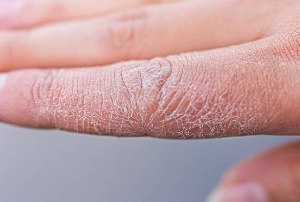 11 порад, як запобігти сухості шкіри взимку - изображение